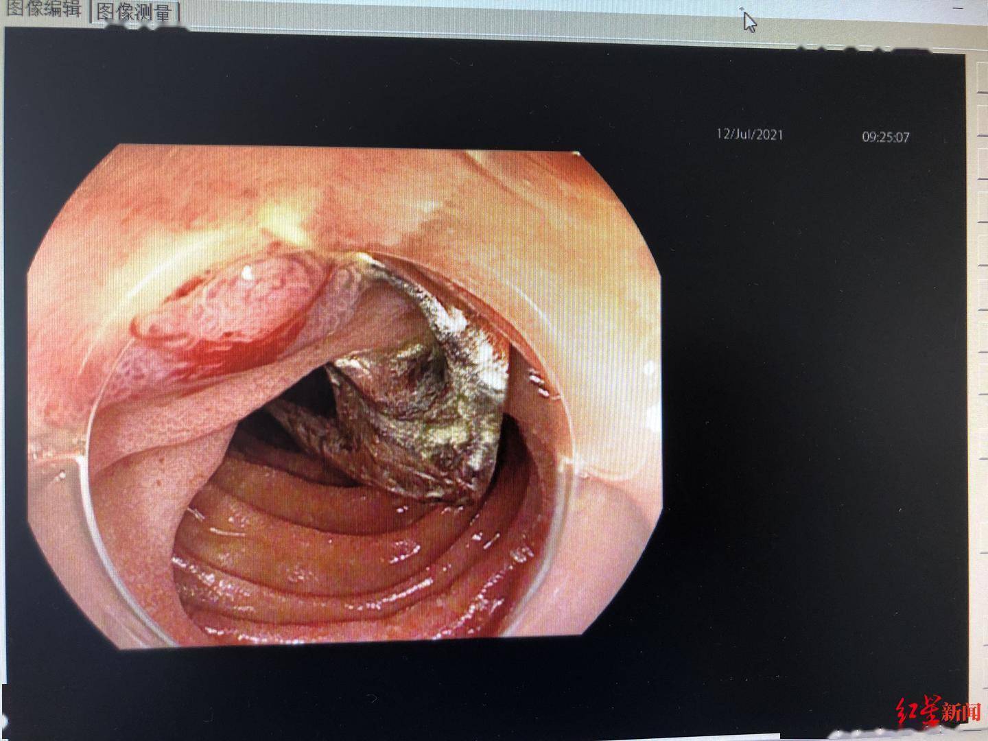男子吃橘子时不慎吞入牙套,一个多月后腹部疼痛 医生:进食莫匆忙
