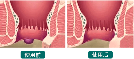 得了痔疮,到底有多羞耻!