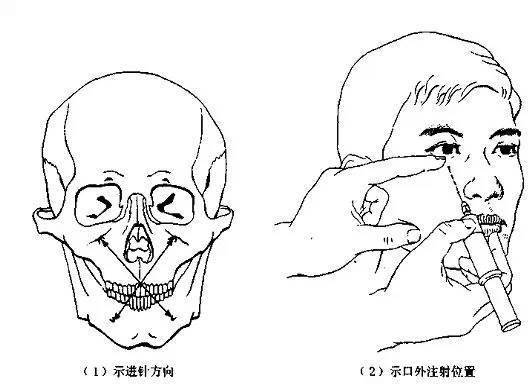 (3)眶下神经阻滞麻醉 口外注射法(成人唇裂,上唇,面部外伤,上颌前牙