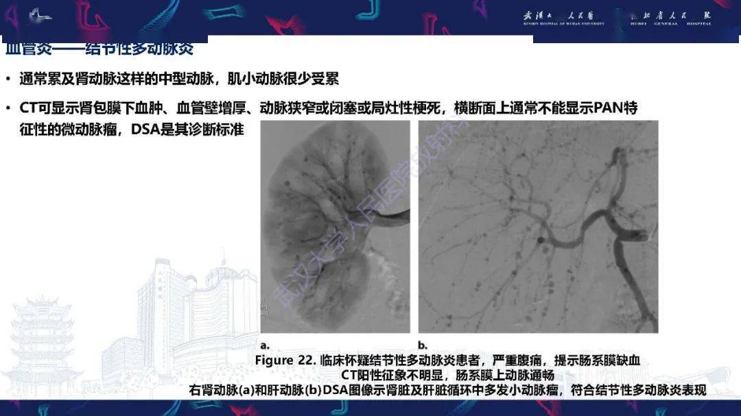 肾动脉解剖病理及血管内治疗