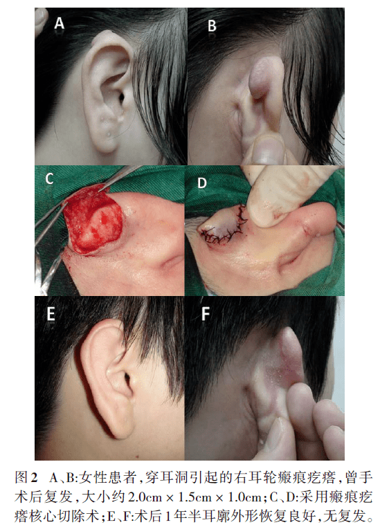 复发性耳部瘢痕疙瘩的形态特征及疗效观察