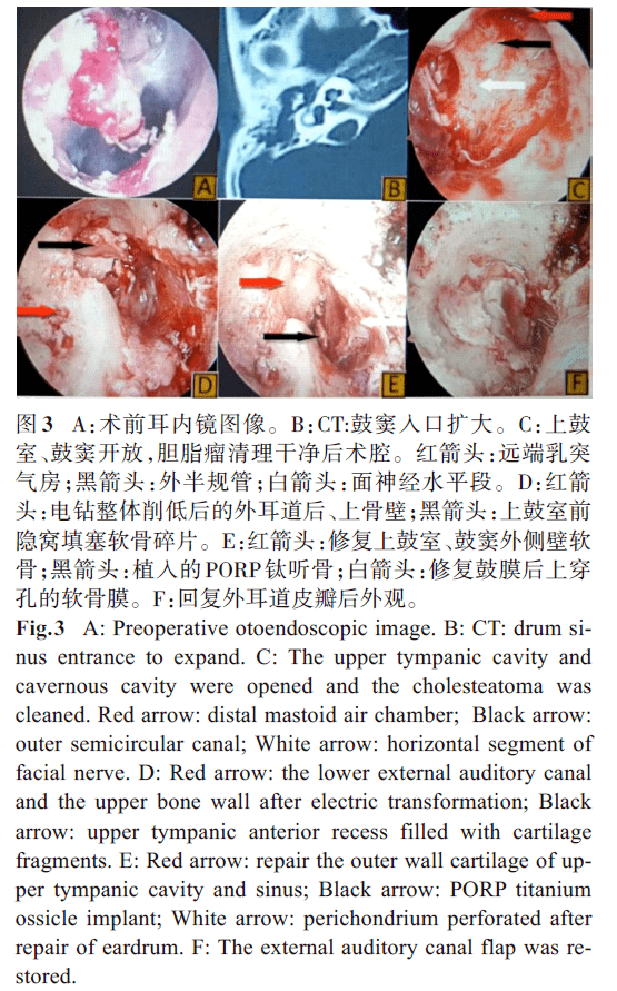 3.3 上鼓室-鼓窦-乳突开放术(3 组)