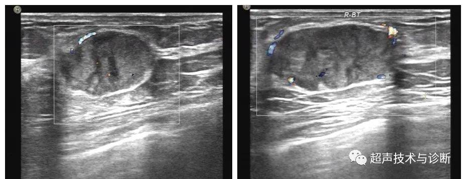 乳腺叶状肿瘤的超声表现