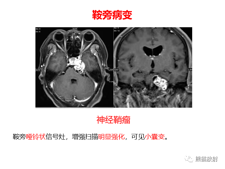 省立影像读片鞍区肿瘤2108