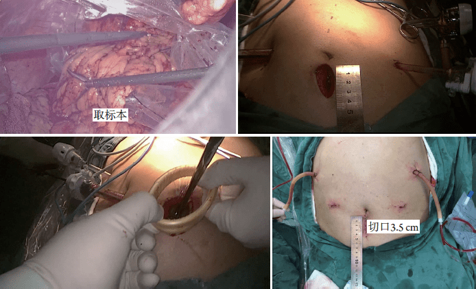 李伟华:腔内uncut roux-en-y吻合术在腹腔镜全胃切除术消化道重建中的