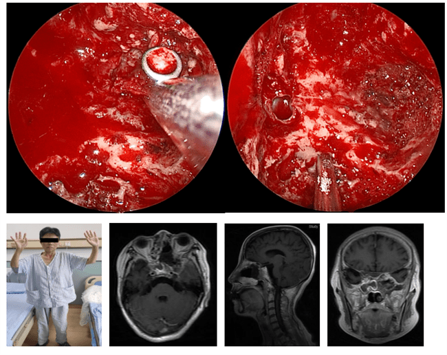 手术|哈医大一院完成内镜下复杂颅内外沟通病变手术