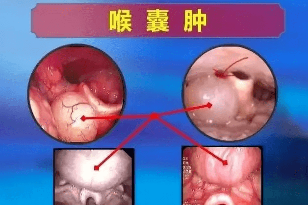 声带息肉,声带小结,任克氏水肿,会厌囊肿,声带沟,声带接触性肉芽肿等
