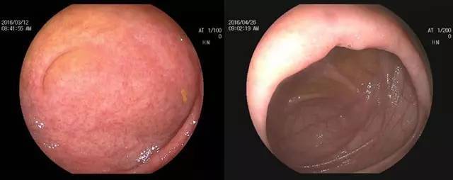 检查|西安马应龙肛肠医院内镜中心：你不明白肠镜检查这些事，算是白活了！