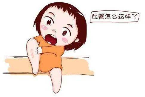 静脉曲张真"恼人!
