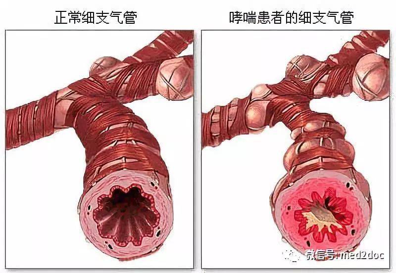 哮喘严重可致死患哮喘的原因竟然是因为这个上班族要注意了