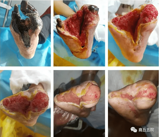 4级缺血性糖尿病足保肢成功,再渺小的希望都有无限可能