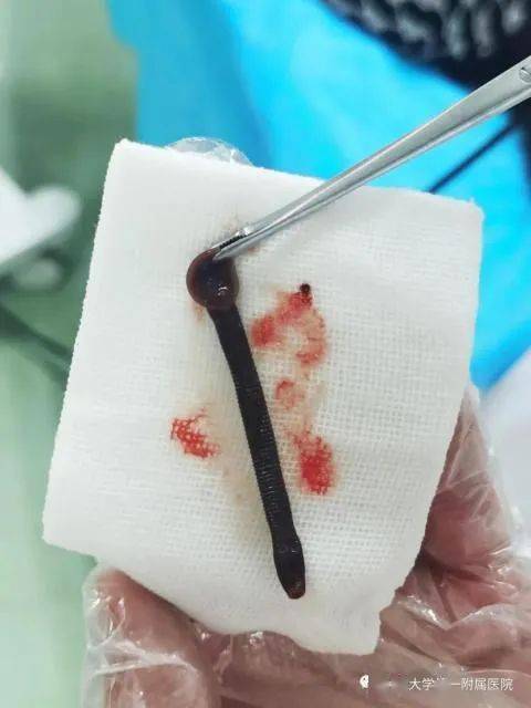 16岁女孩总流鼻血,医生竟从她鼻腔里取出一条活的