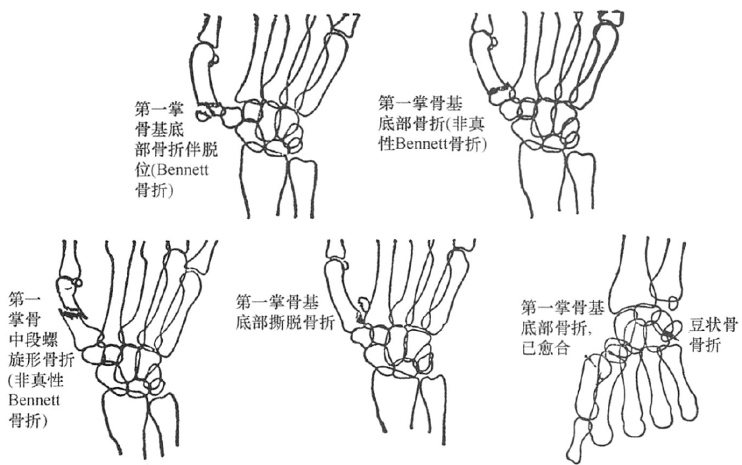 第一掌骨骨折(bennett骨折)