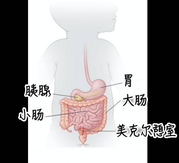 有美克尔憩室的患者,大多数一辈子都没有任何症状.