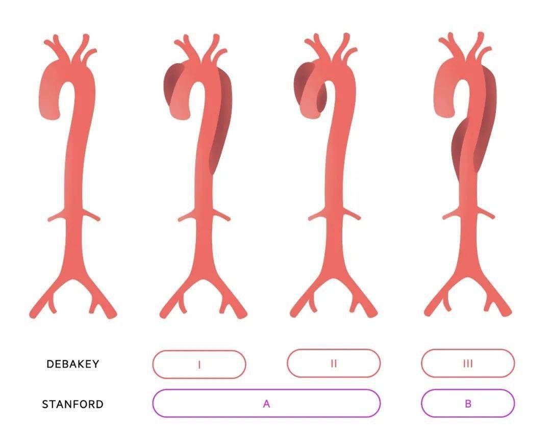 收藏级,主动脉夹层分型(精美插图版)