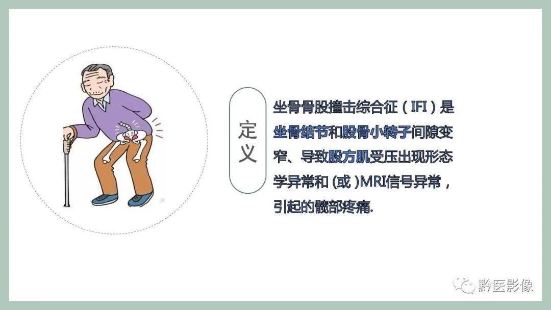 坐骨股骨撞击综合征(ischio-femoral impingement, ifi)影像学诊断