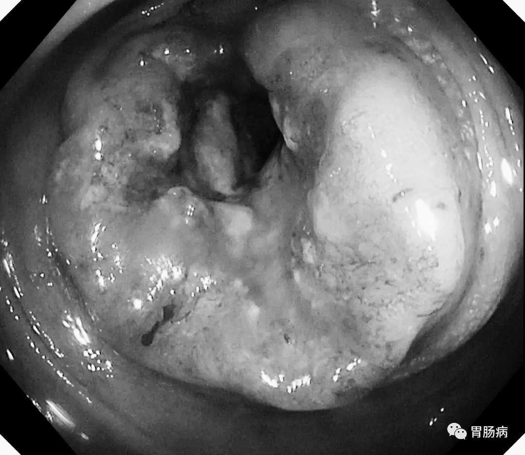 距肛门25—28cm处,巨大肿物,肠镜勉强通过,病理确诊为结肠癌.