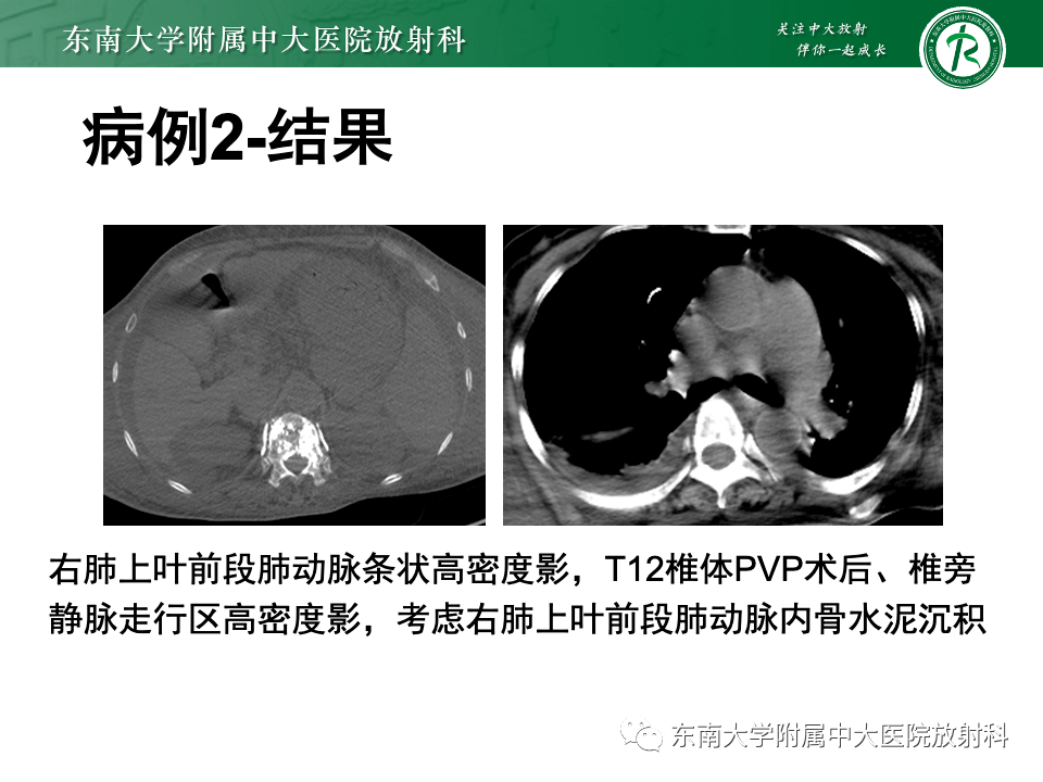 骨水泥肺栓塞影像表现