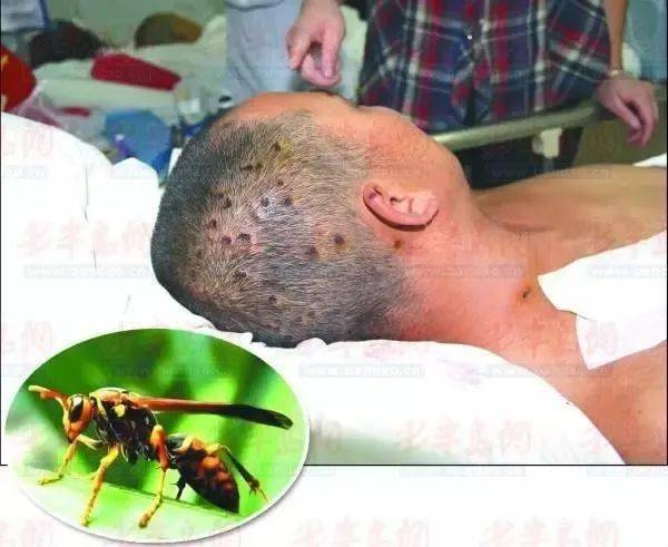 一般指被10只以上的蜂群攻击,大量蜂毒进入体内后会 导致中毒,造成肾