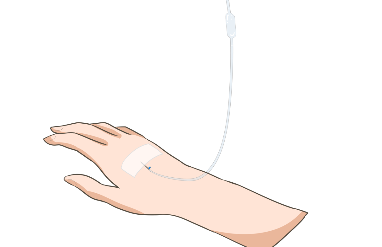 淋巴|化疗患者需要长期保留静脉导管吗？