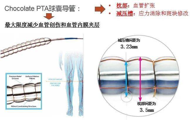 记华美血管外科团队治疗动脉血管堵塞新模式:巧克力球囊 药涂球囊