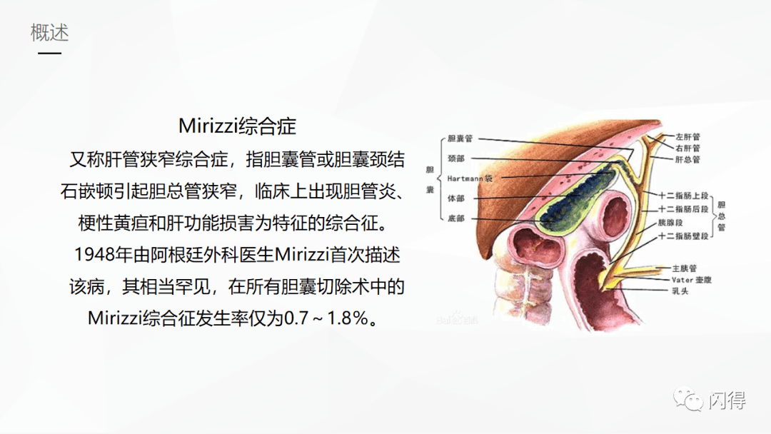 【ppt】mirizzi综合征护理_闪得