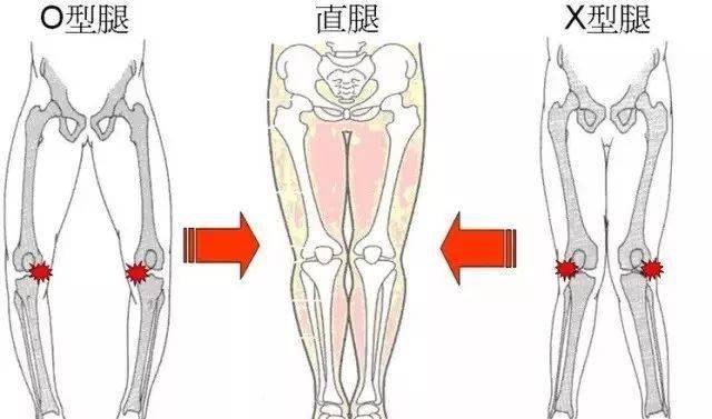 o型腿矫正,由o到11,弯腿变美腿