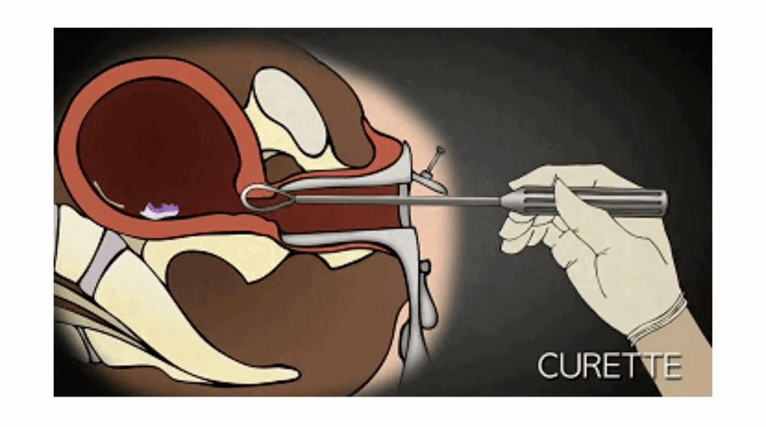 子宫虹膜吸出宫腔2,第二步:如果需要,用扩宫棒扩张宫颈管,以便使手术