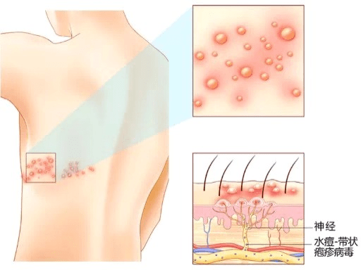 痛到怀疑人生的带状疱疹蛇缠腰有疫苗了建议50岁以上人群接种