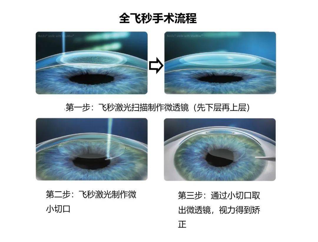 两分钟搞定一台近视手术!_角膜