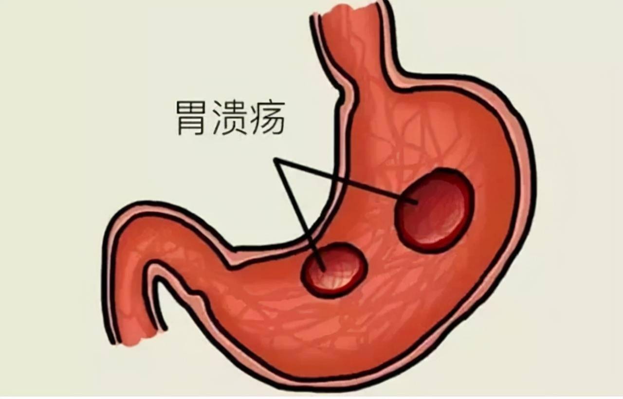胃溃疡吃什么养胃?提醒:胃不适,不妨常吃这9种养胃食物