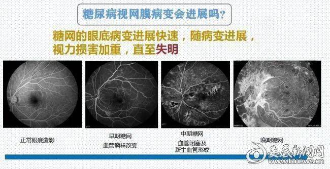 糖尿病视网膜病变为工作年龄(20-60岁)人群最常见的致盲眼病,且致盲