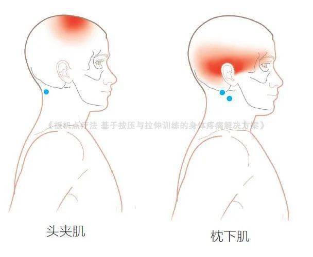 头痛不一定是睡得不好,还可能是扳机点在作怪!