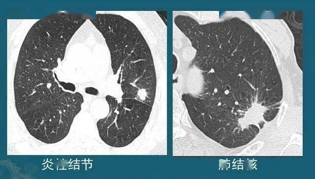 伴有胸膜牵拉 图4 这种结节有时单纯从ct片的形态分析,跟肺癌鉴别