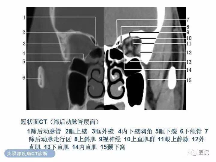 正常眼眶的ct解剖_微信