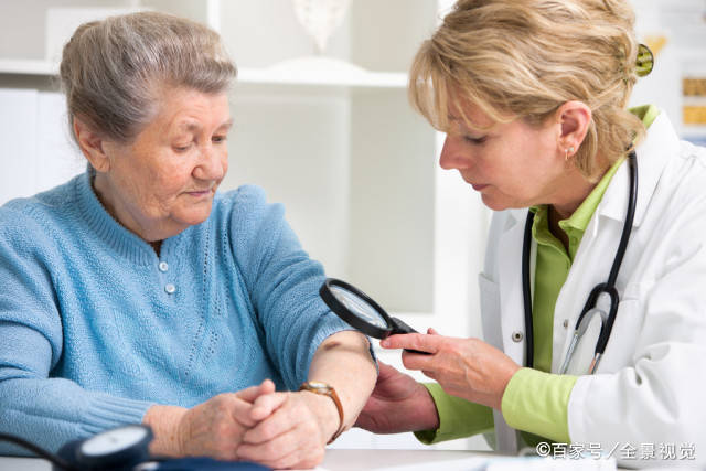 肝脏|辟谣！皮肤长红痣是肝病标志？其实可能是3种情况，很多人都搞错