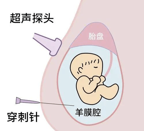 二,什么人需要做羊膜腔穿刺呢