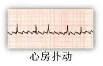 心脏电生理诊断与治疗