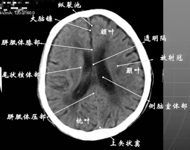 7大脑皮质下部层面(半卵圆中心层面)在胼胝体和侧脑室上方,大脑镰自前