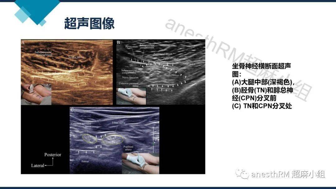 超声引导下腘窝坐骨神经阻滞