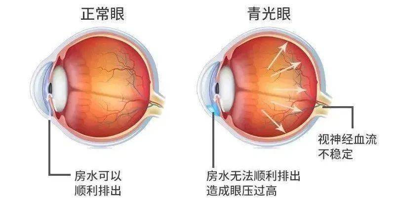 一旦确诊,急诊的医生会用到多种局部点眼,全身输液和口服的降眼压药物