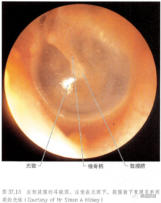 左侧鼓室内侧壁前外侧面观听小骨(锤骨,砧骨,镫骨)面神经颞内段以及