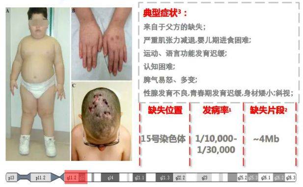 6.  prader-willi综合征(小胖威利综合征)