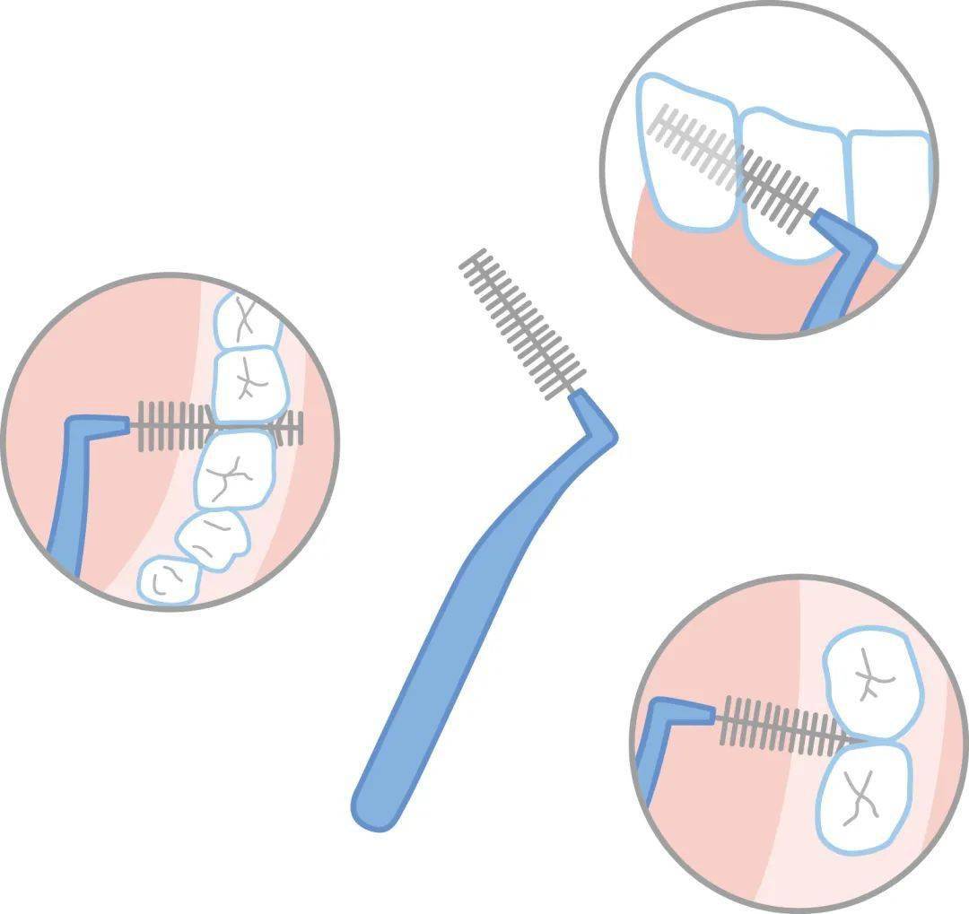 如果你的牙缝比较明显,牙医一般会推荐你用  牙缝刷,它的清洁效率最高