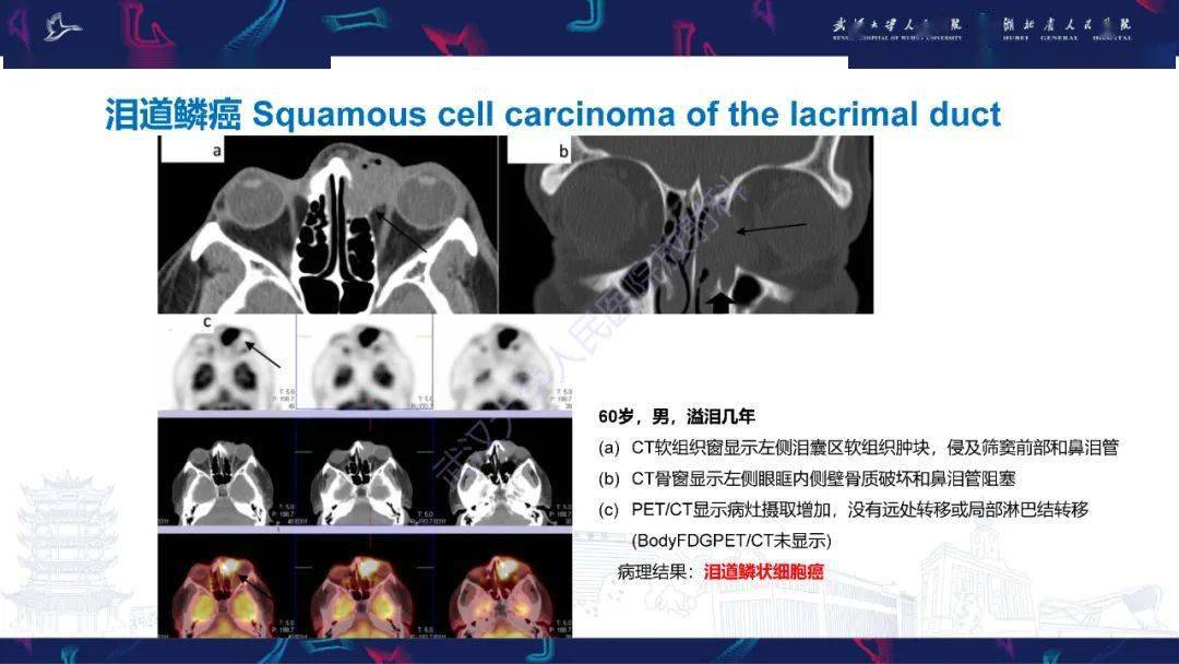 泪道病变影像诊断_全网_解剖图_系统