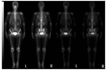 全身骨扫描扫描辐射副作用大不大