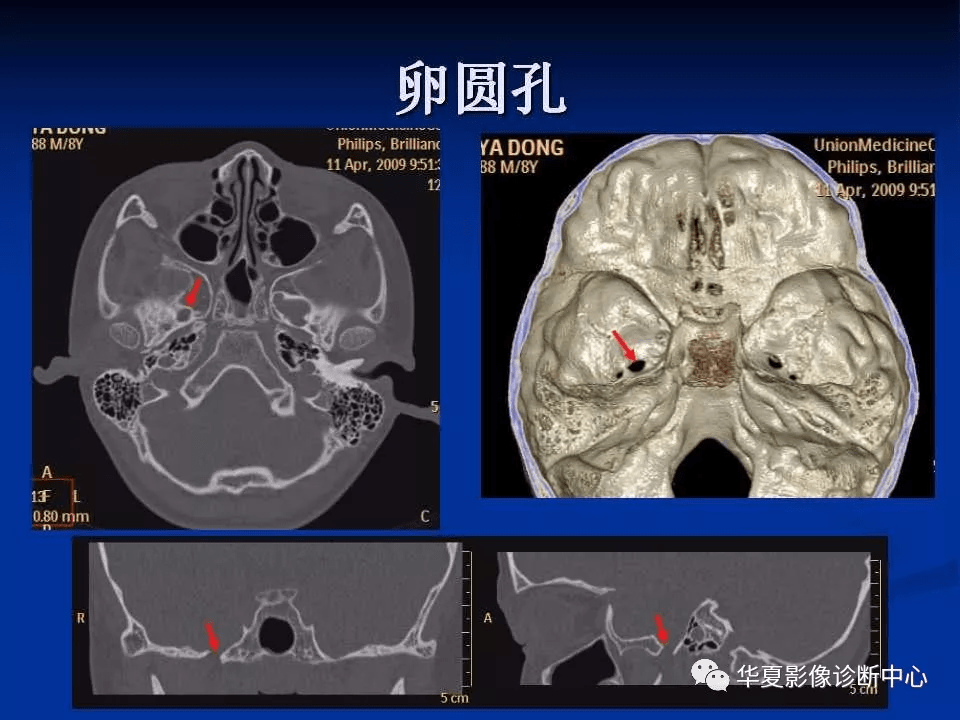 实用,详细的颅底各孔道影像解剖_结构_动脉_神经