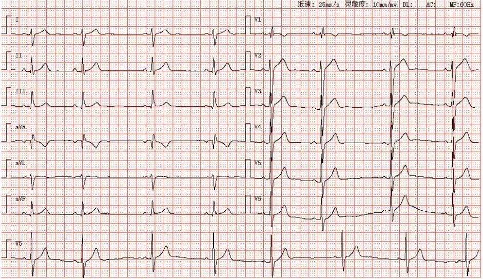心电图图谱 2如图所示,p波在,avf,v4-v6导联直立向上,avr导联