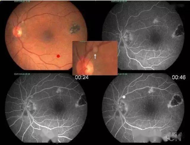 常见眼科病例的眼底照片集锦_视网膜_变性_黄斑