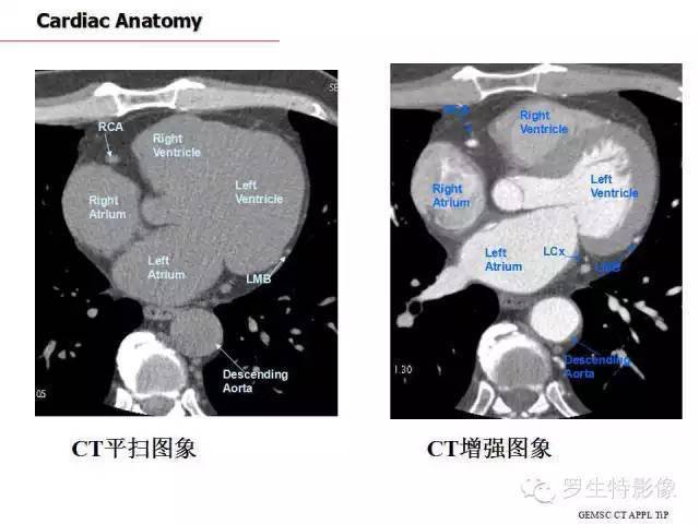 冠脉冠状动脉疾病报告与数据制度(cad-rads):美国心血管ct学会(scct)